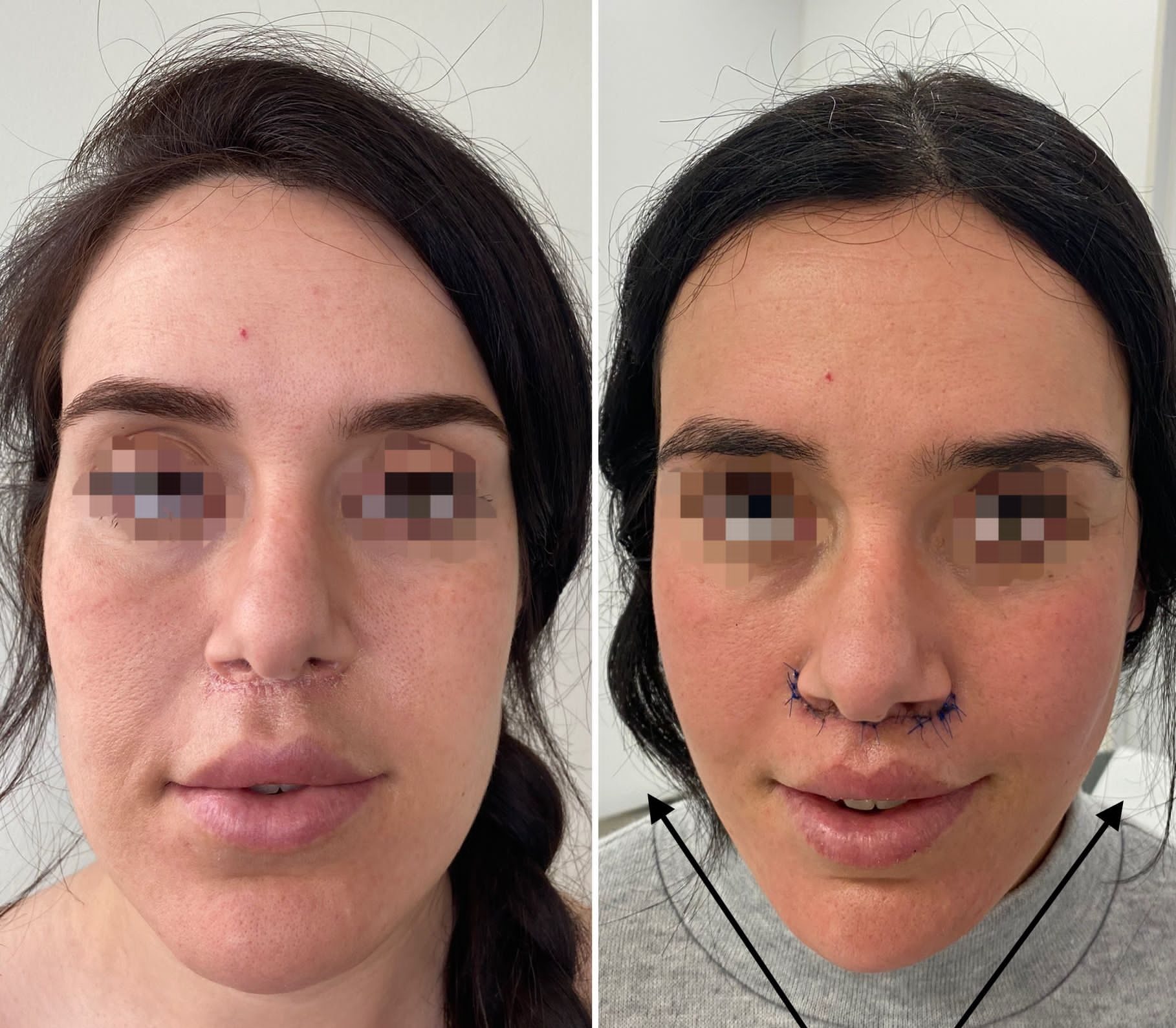 mini lifting facial antes y despues 