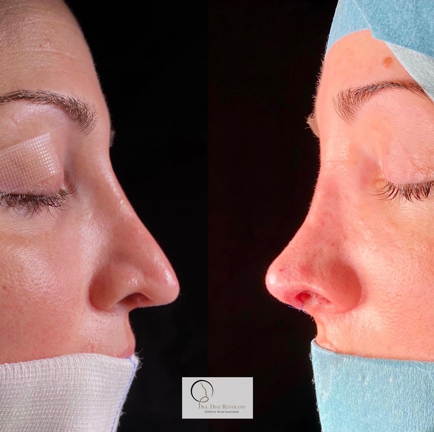 Rinoplastia ultrasonica secundaria antes y despues en barcelona