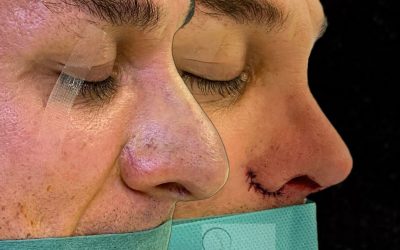 Nariz con punta caída: causas y cómo corregirla con rinoplastia