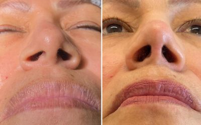 Problemas para respirar por la nariz: cuándo la cirugía nasal es la solución definitiva