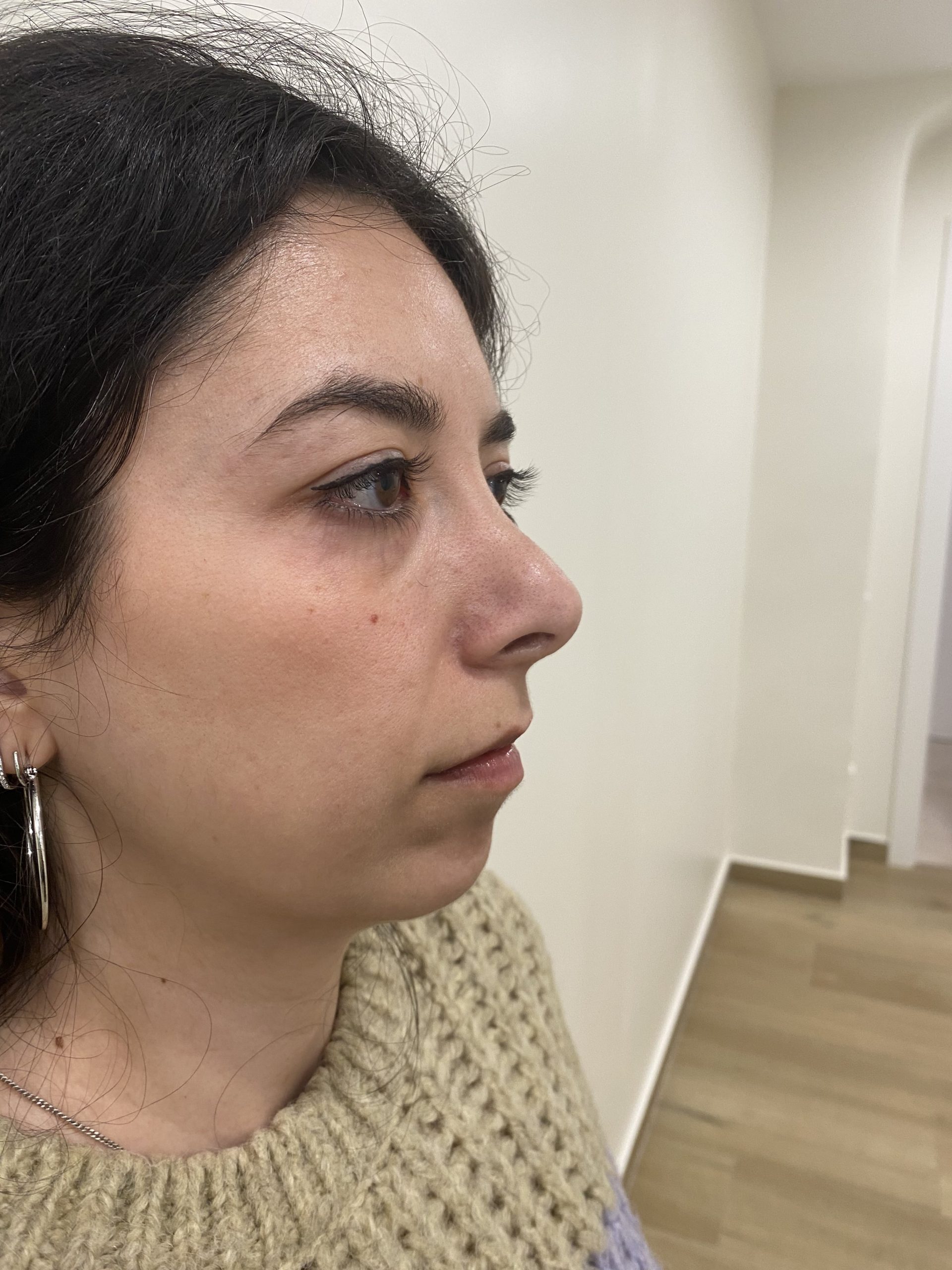 rinoplastia-secundaria-barcelona-antes