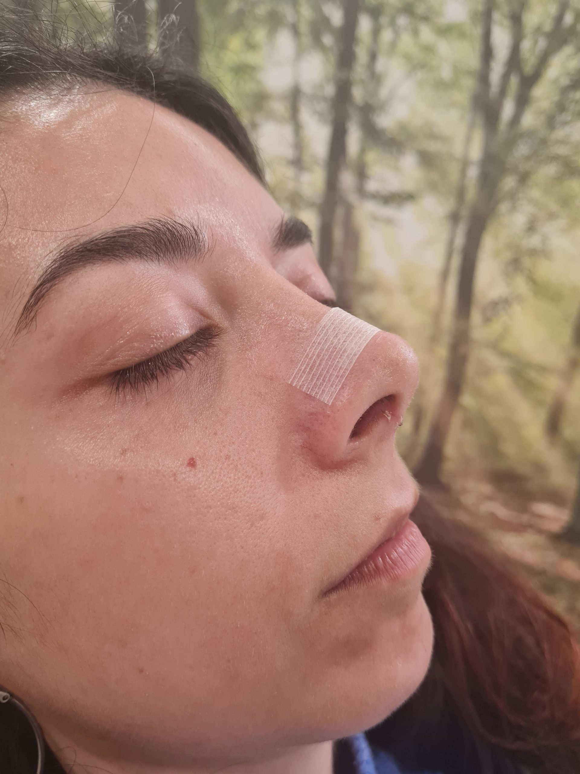 rinoplastia-secundaria-barcelona-revision