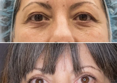 blefaroplastia superior