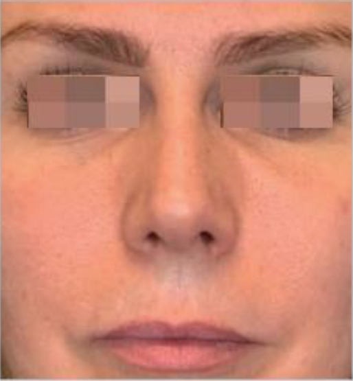 Ultracol-tratamiento-antes-despues-caso-3-after imagen de mujer despues de aplicar ultracol