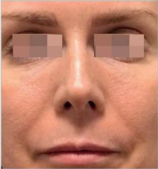 Ultracol-tratamiento-antes-despues-caso-3-before imagen de mujer despues de aplicar ultracol