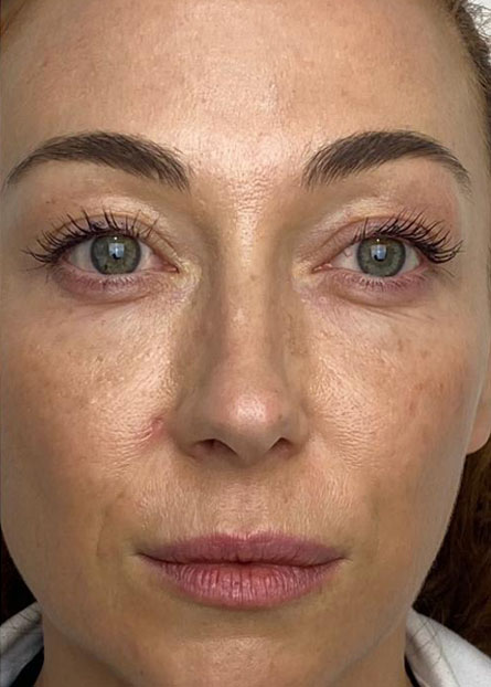 Ultracol-tratamiento-antes-despues-caso-7-after imagen de mujer joven despues de aplicar tratamiento ultracol