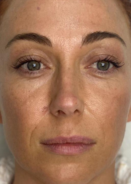 Ultracol-tratamiento-antes-despues-caso-7-before Imagen Mujer joven antes de tratamiento con untracol