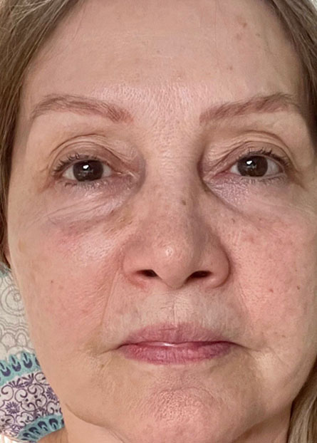 Ultracol-tratamiento-antes-despues-caso-8-after Imagen mujer mayor despues de tratamieto con ultracol
