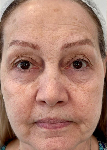 Ultracol-tratamiento-antes-despues-caso-8-before mujer mayo antes de tratamiento ultracol