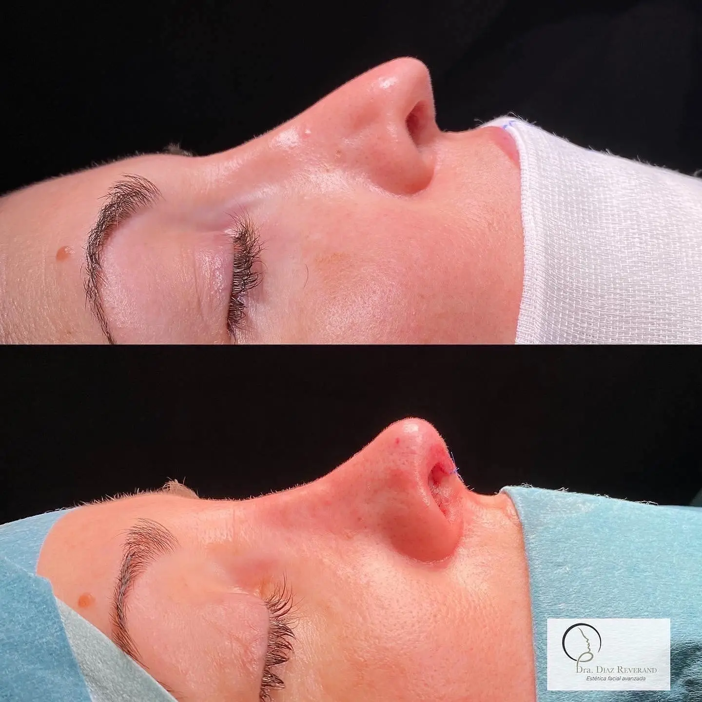 rinoplastia ultrasonica barcelona 2025 antes y despues 
