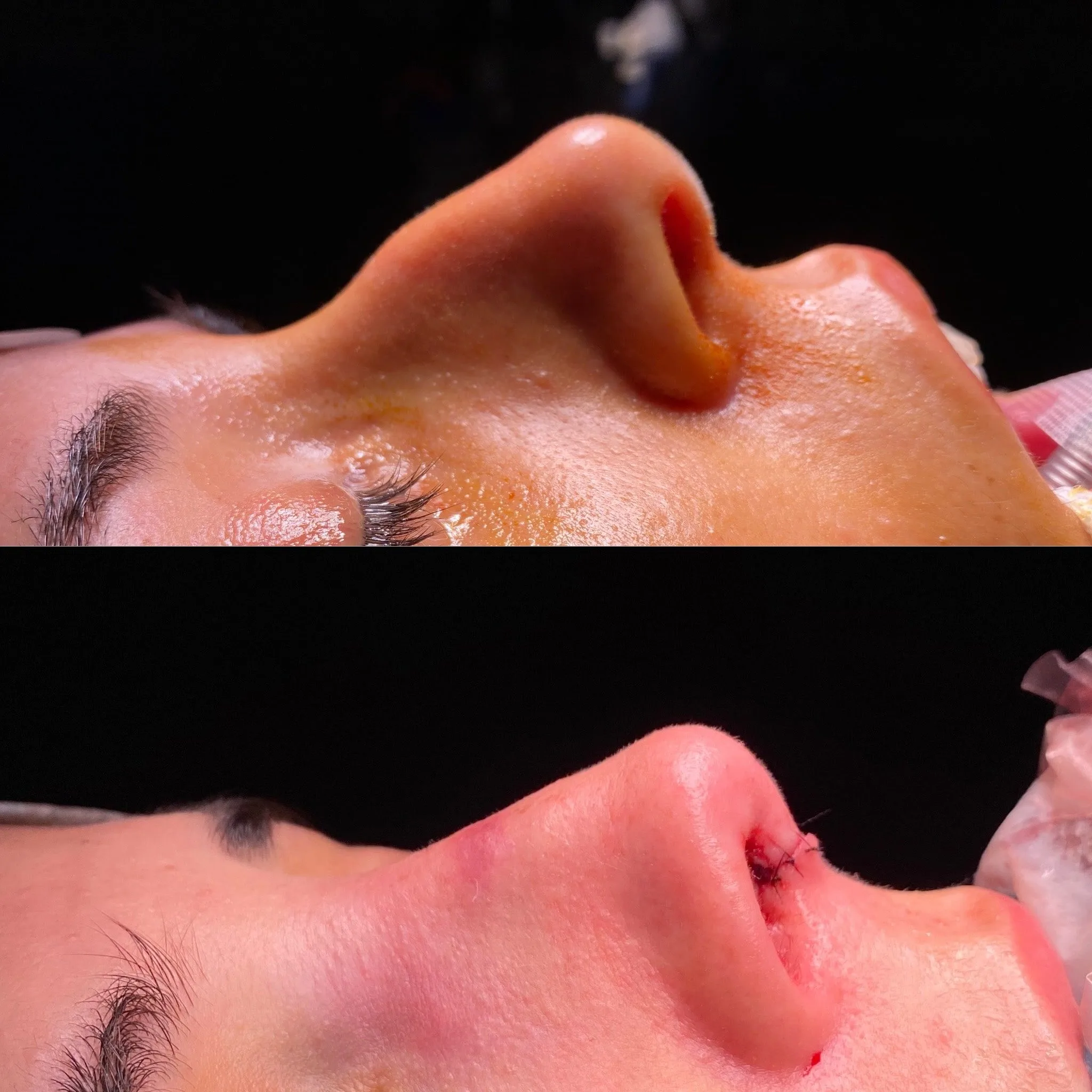 rinoplastia ultrasonica antes y después