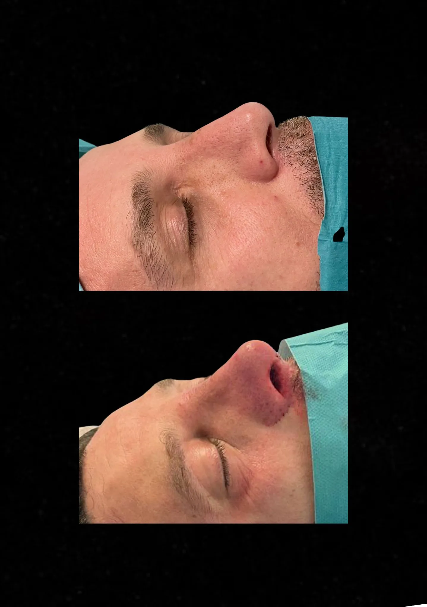 rinoplastia-de-revision-caracas-venezuela Paciente antes y después de una rinoplastia secundaria en caracas