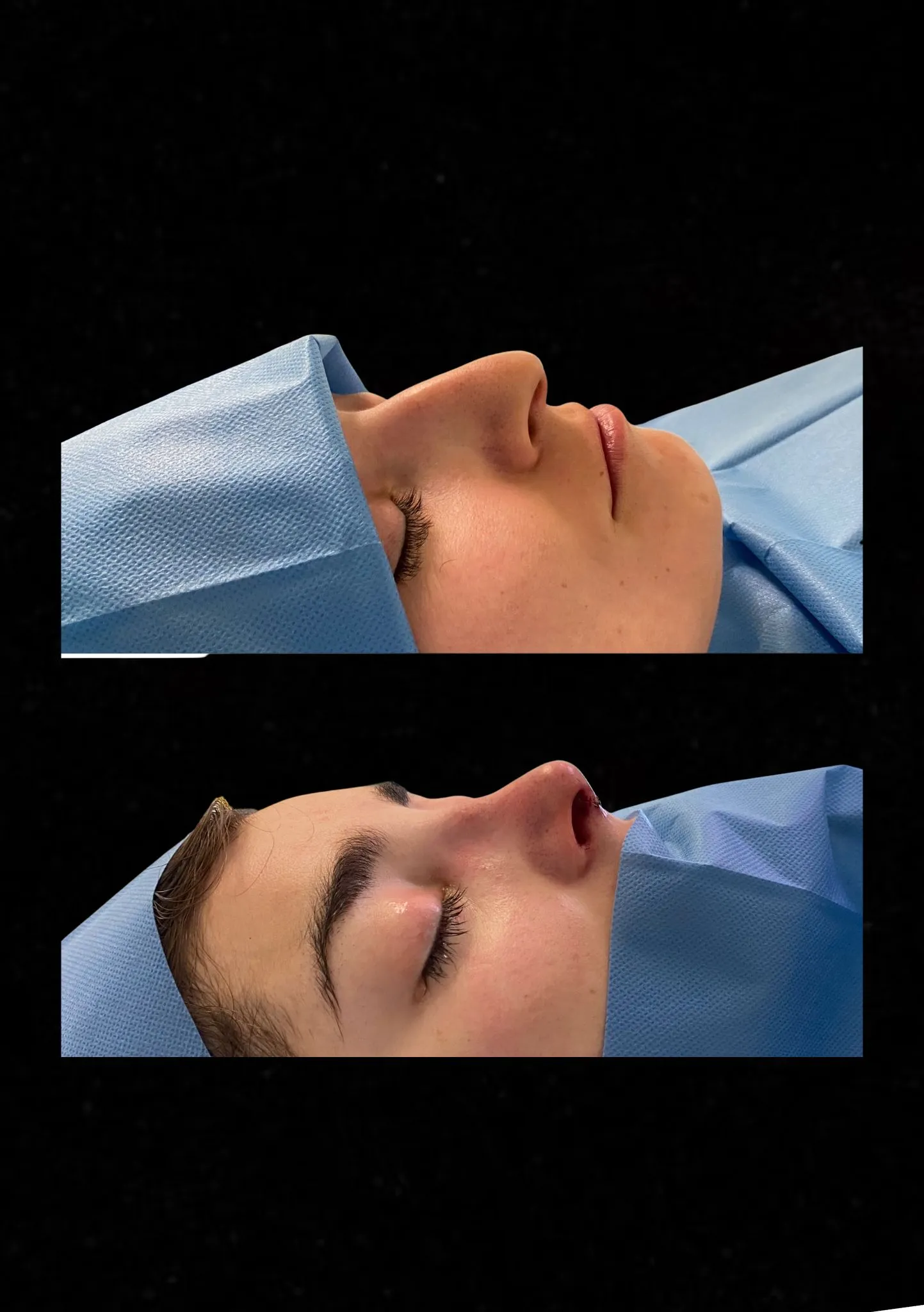 rinoplastia ultrasonica en barcelona 2025