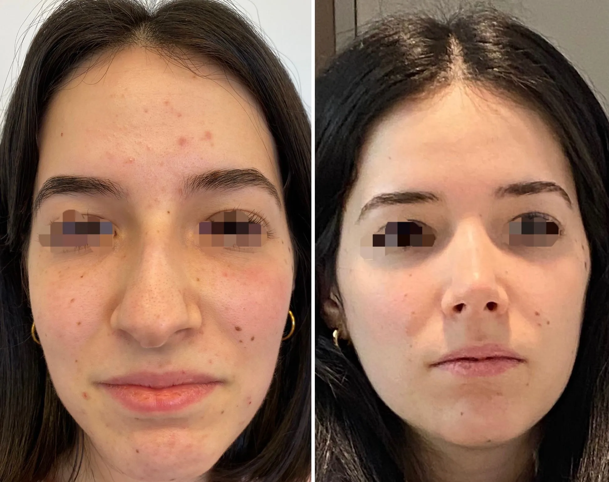 rinoplastia ultrasonica antes y después barcelona