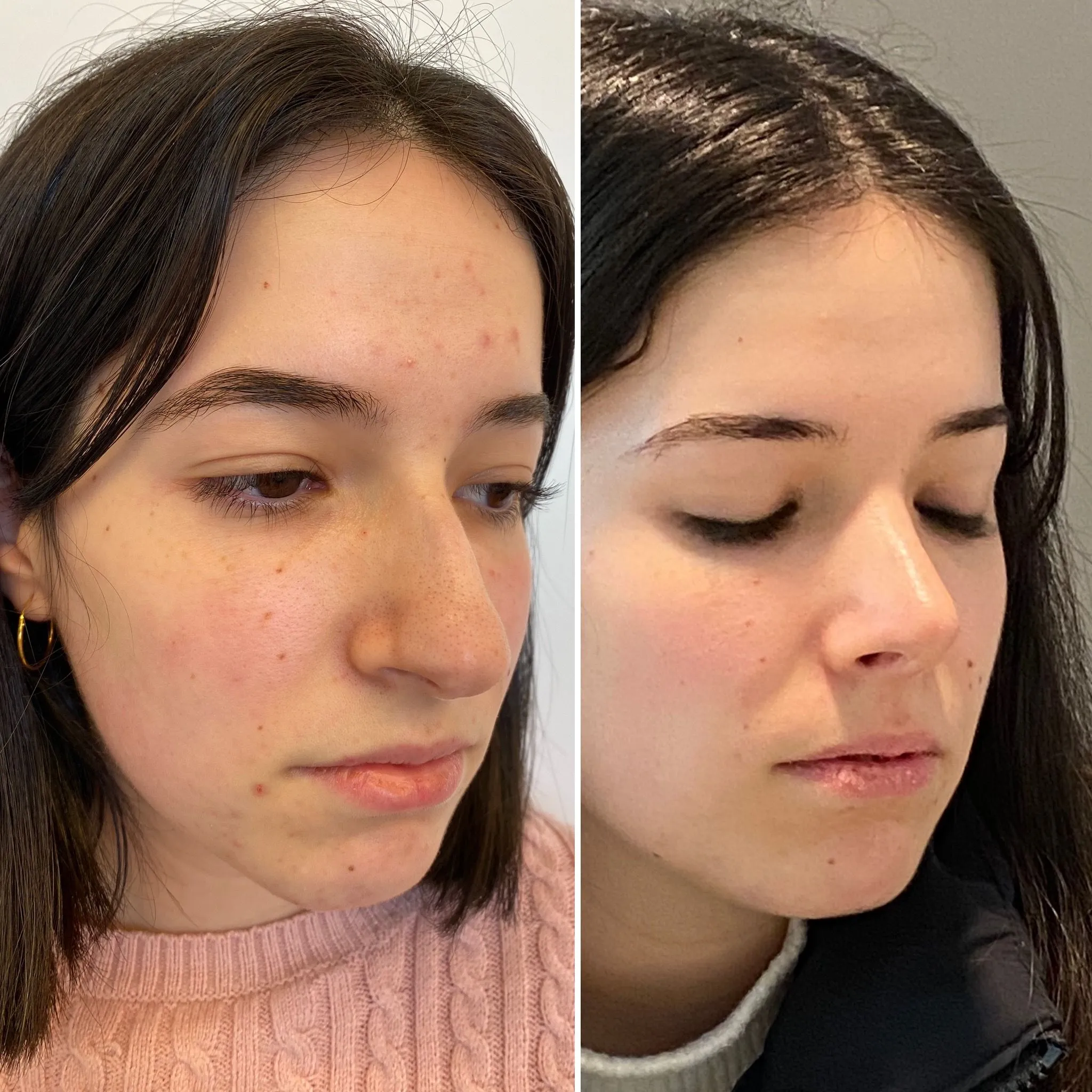 rinoplastia ultrasonica cirugia 2025 en barcelona