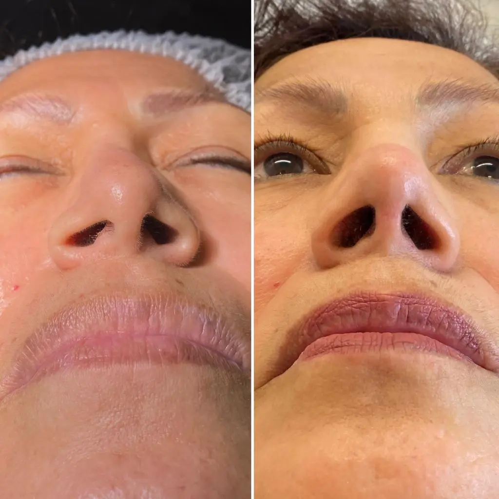 Paciente antes y después de una rinoplastia secundaria