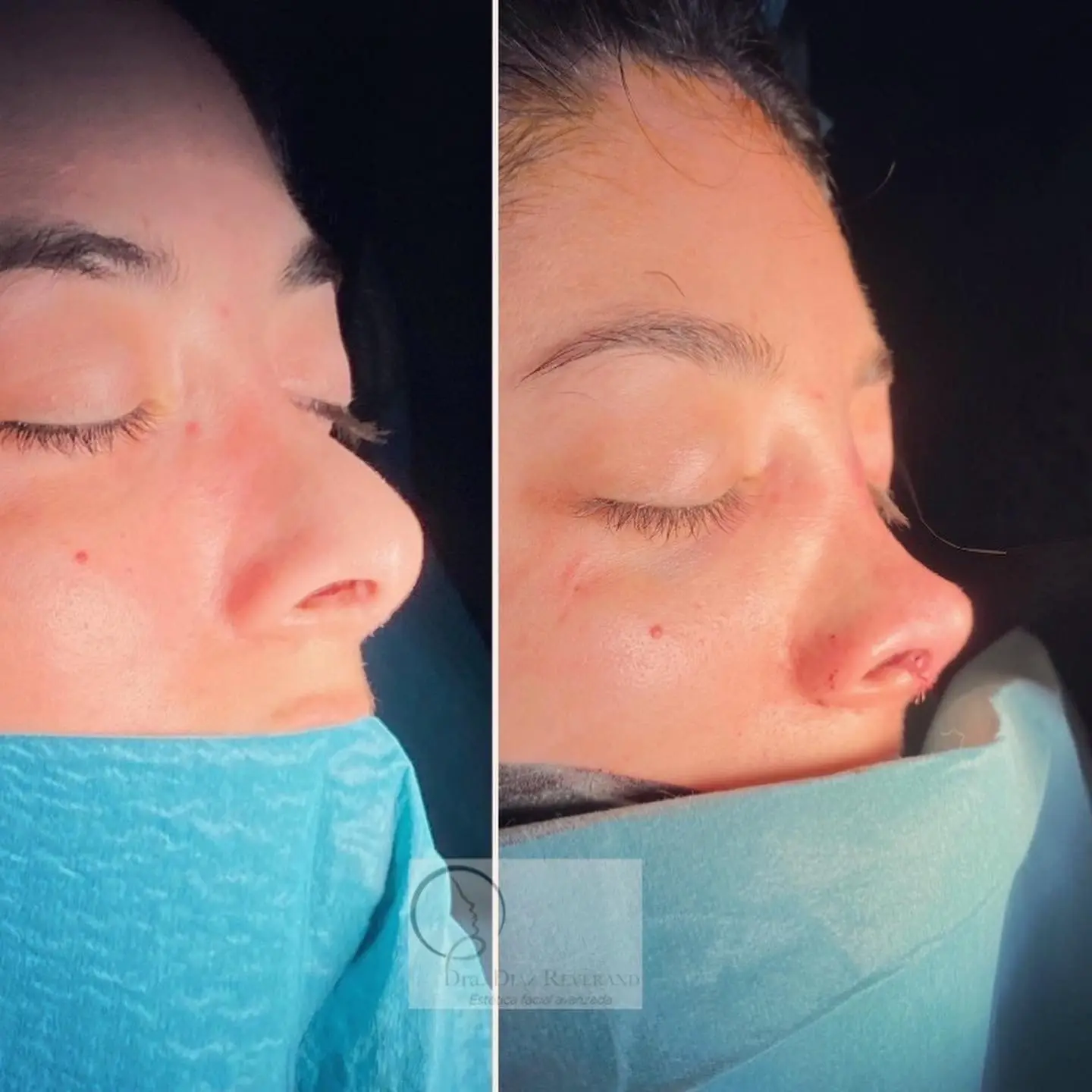 rinoplastia-secundaria-barceloina rinoplastia secundaria antes y despues barcelona 2025