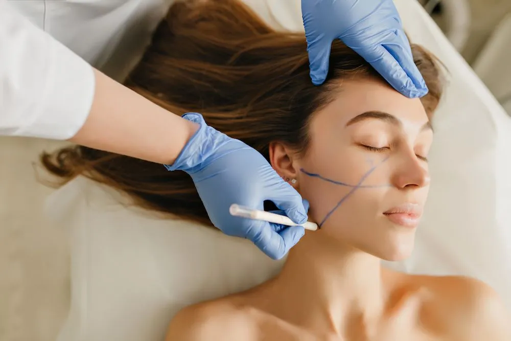 Mujer en postoperatorio de bichectomía con marcación azul en las mejillas para guiar la extracción de las bolas de Bichat.
