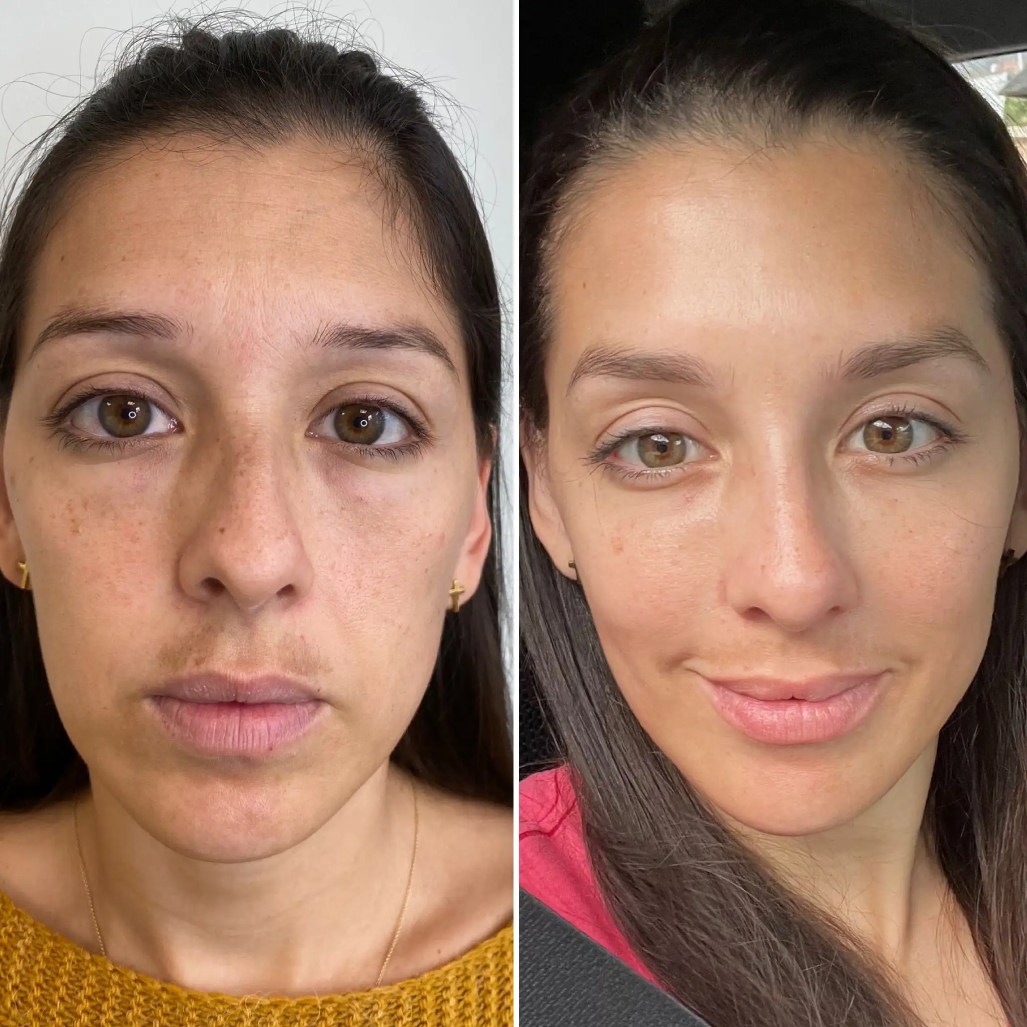 Total-face-estetica-barcelona Antes y despues de full face en barcelona