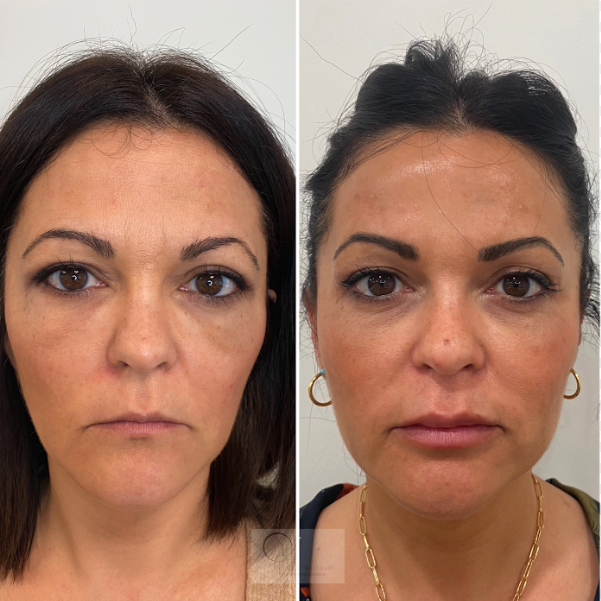 total-face.tratamiento-barcelona Antes y despues de tratamioento total face en barcelona