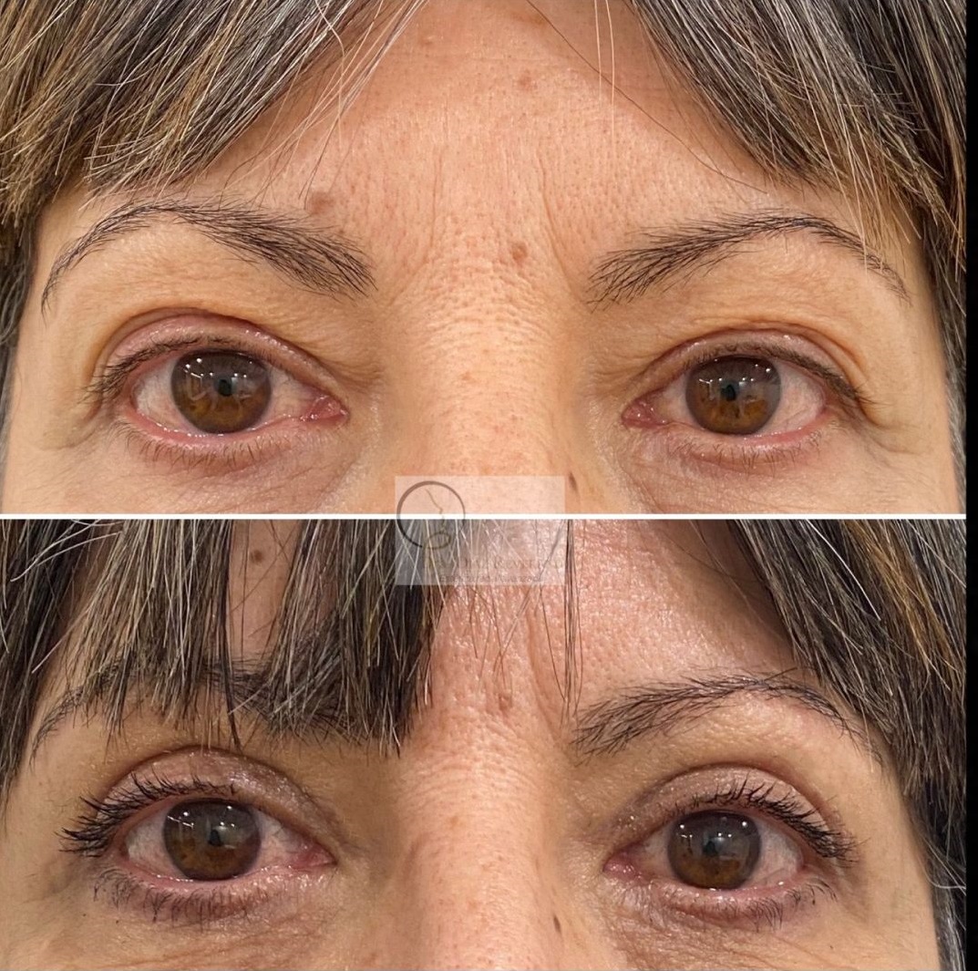 blefaroplastia-superior-barcelona-precio-1280x1706