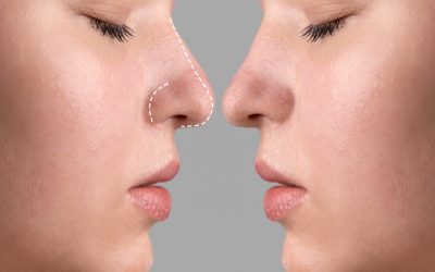 Nariz asimétrica: causas, consecuencias y cuándo la rinoplastia puede corregirla