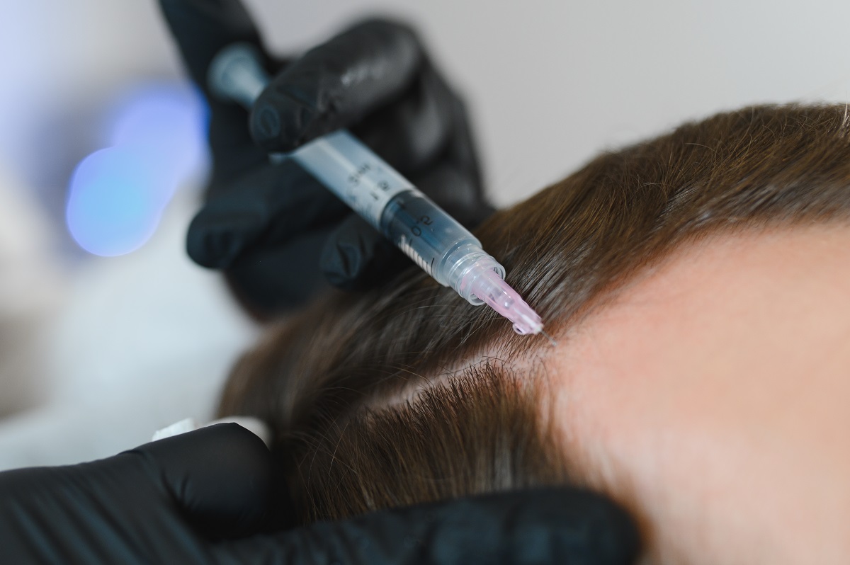 Tratamiento de la alopecia en Barcelona
