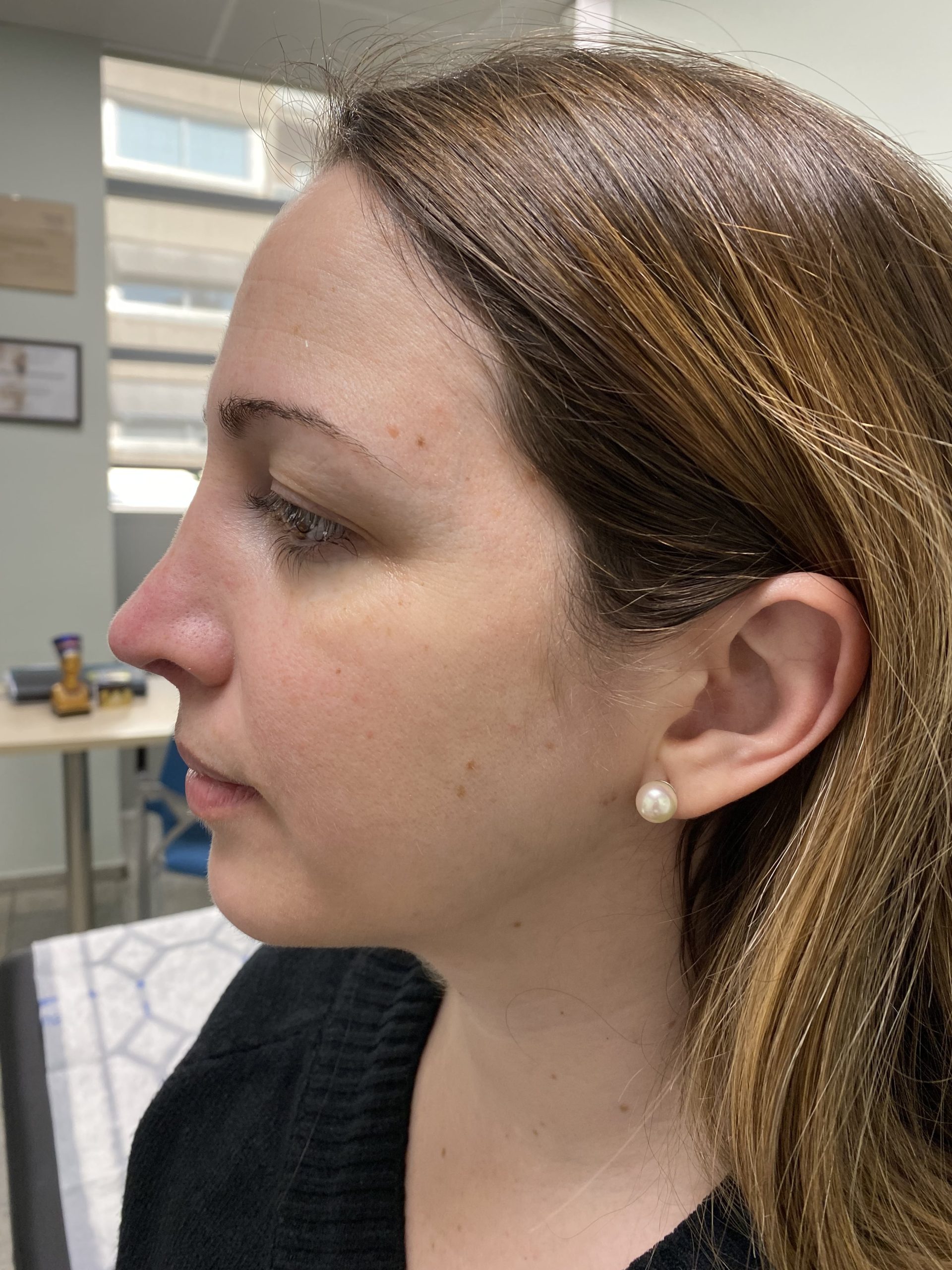 después rinoplastia secundaria barcelona resultado natural