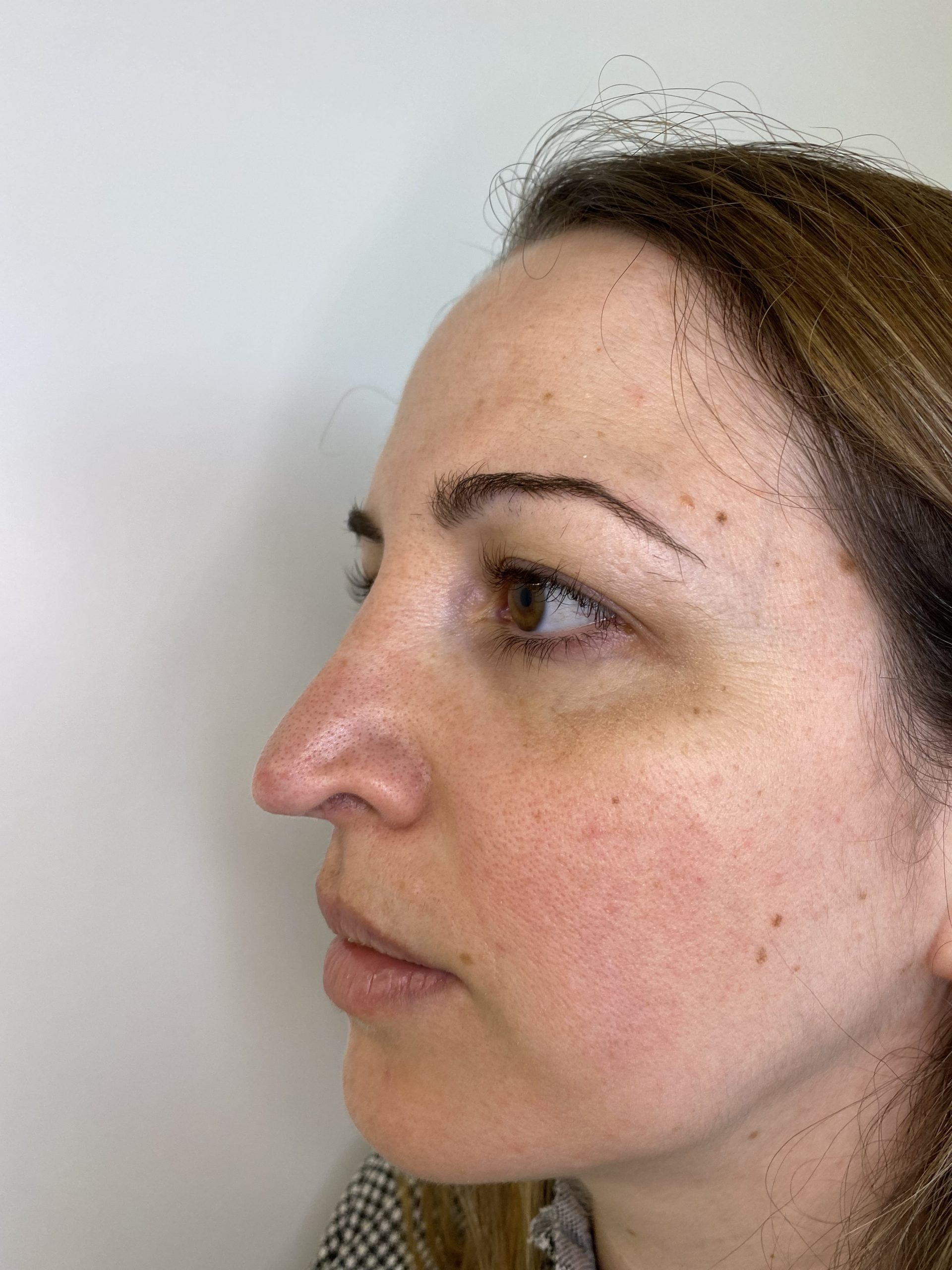 antes rinoplastia secundaria Barcelona